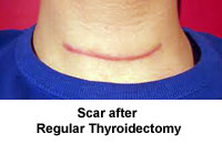 Thyroidectomy Long Scar
