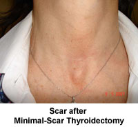 Thyroidectomy Minimal Scar